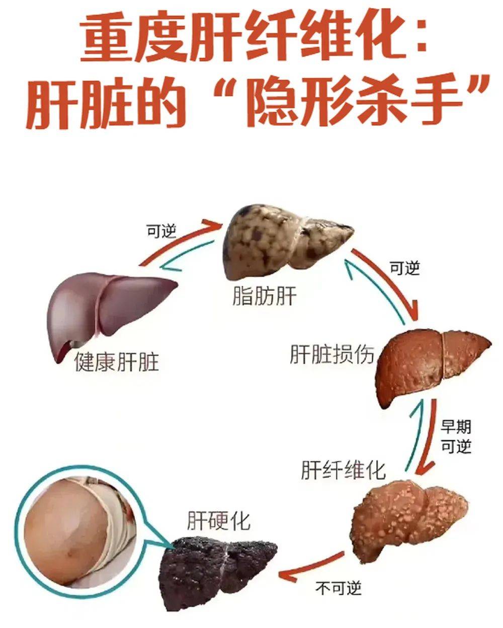 皇冠信用網登2代理_山东网红“草帽姐”自曝患肝纤维化终生无法康复皇冠信用網登2代理，劝粉丝不要经常生气，专家提醒